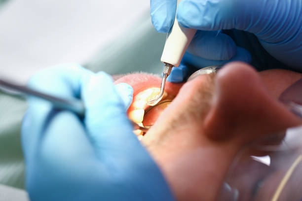 Best Emergency Dentist for Knocked-Out Tooth in Pacolet, SC